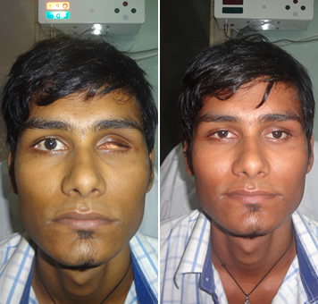 eye before and after surgery