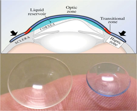 Scleral contact lenses